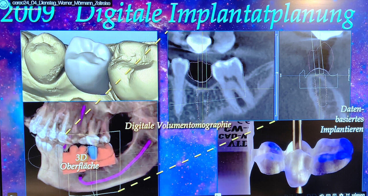 Abb. 6: In mehreren Entwicklungsstufen wurde ab 2009 das datenbasierte Implantieren in der Cerec-Software hinterlegt.