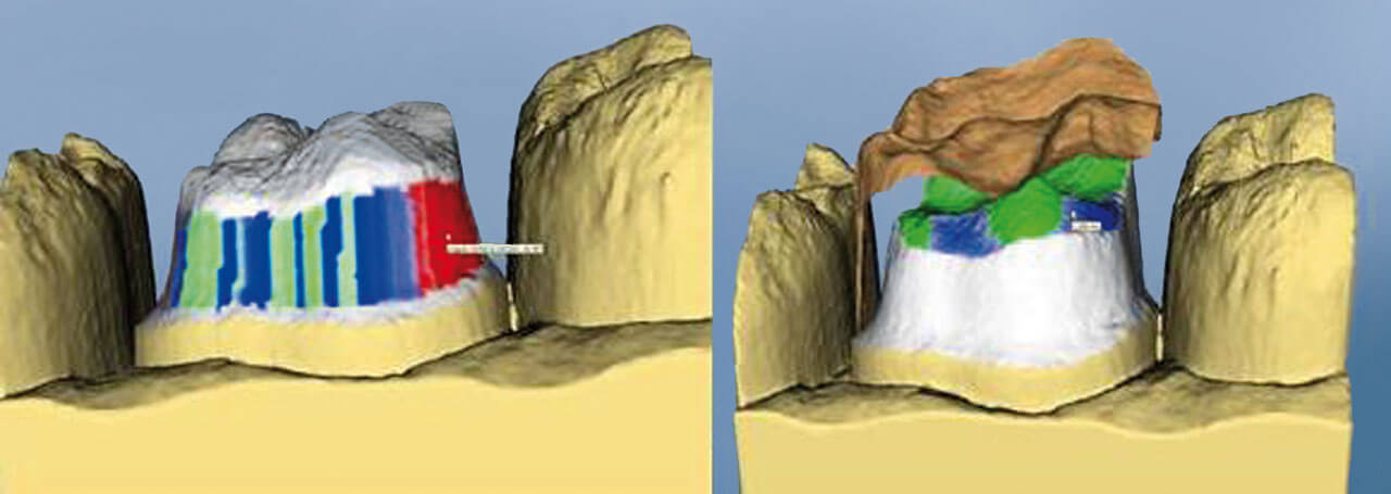 Abb. 1: Die Software kontrolliert die Effizienz der Präparation. Zu dünne Wandstärken für vollkeramische Kronen werden deutlich gekennzeichnet und fordern zur Korrektur auf.