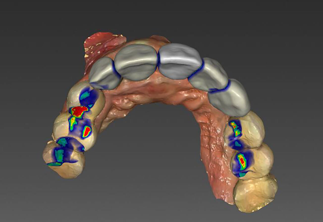 Abb. 2: Virtuelle Konstruktion einer definitiven, implantatgetragenen Brücke mit Justierung der okklusalen Kontakte im Rahmen der Rückwärtsplanung, bevor die chirurgische und prothetische Behandlung erfolgt.