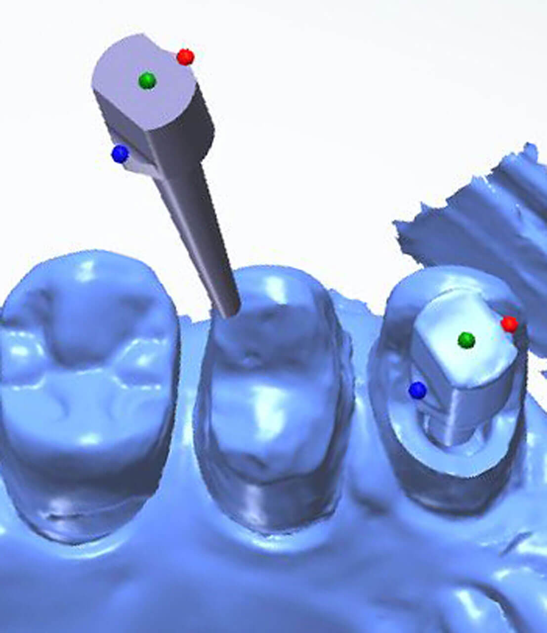 Abb. 3: Endo-Prothetik – Positionierung des Scanpost-Datensatzes über eine Dreipunkt-Überlagerung zur Bestimmung des Wurzelkanallumens.