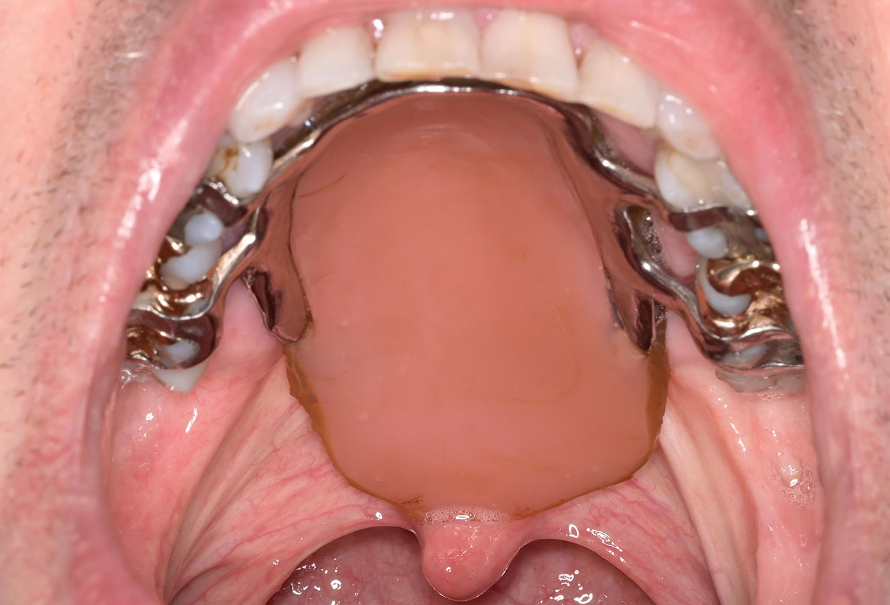 Ein Obturator (Defektprothese) verschließt den Defekt am Gaumen und trennt die Mundhöhle wieder von der Nasenhöhle. Trinken, Essen und Sprechen sind für den Patienten wieder problemlos möglich.