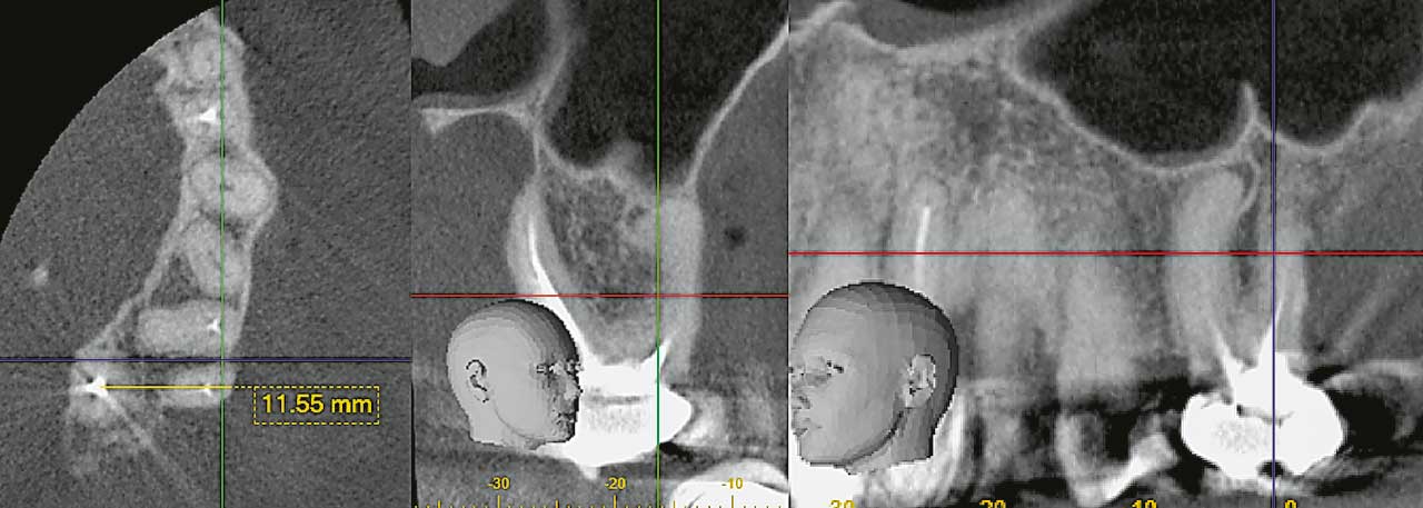 Abb. 1  Axiales, koronales und sagittales Schnittbild (DVT) eines Oberkiefermolaren. Die apikale Parodontitis ist nur mesiobukkal nachweisbar. Grund für die Pathologie ist wahrscheinlich der nicht therapierte Wurzelkanal (mb2). Das axiale Schnittbild zeigt die Distanz der Wurzeln zueinander. Eine (pauschale) WSR an allen Wurzeln ist nicht indiziert und würde zudem durch eine zu überwindende Distanz von über 1,1 cm bei vestibulärem Zugang einen erheblichen Gewebeschaden verursachen.