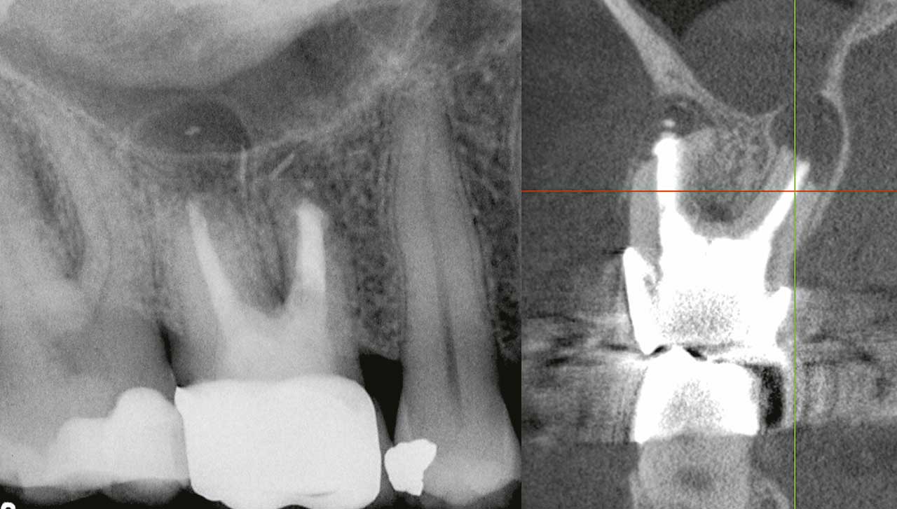 Abb. 2  Zahn 16 nach mehrfacher Revision und WSR (Röntgenaufnahme und koronales Schnittbild eines DVTs). Reaktive Schleimhautschwellung in der Kieferhöhle mit Auflösung der knöchernen Begrenzung des Kieferhöhlenbodens. Der Zahn wurde als austherapiert angesehen.