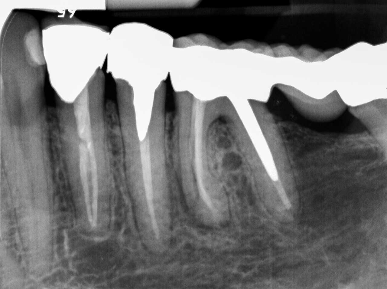 Abb. 10 Röntgenaufnahme der Zähne 33−38: Apikale Parodontitis an der mesialen Wurzel des Zahns 36. Wäre hier nicht eine vertikale Fraktur diagnostiziert worden, hätte man therapeutisch unter Umständen die mesiale Wurzel angehen können.