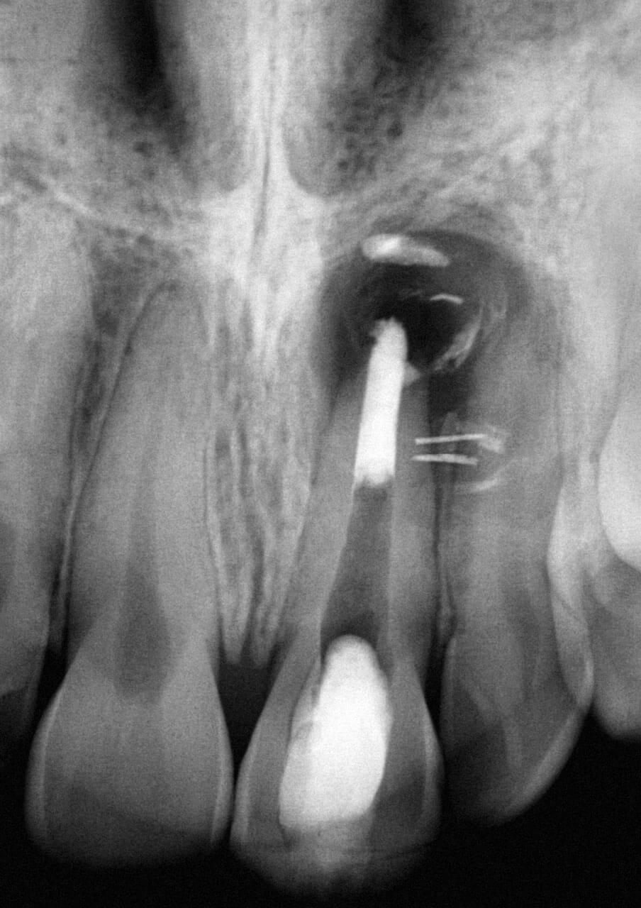 Abb. 7 Radiologische Kontrolle des apikalen Plugs mit überpresstem Füllmaterial.