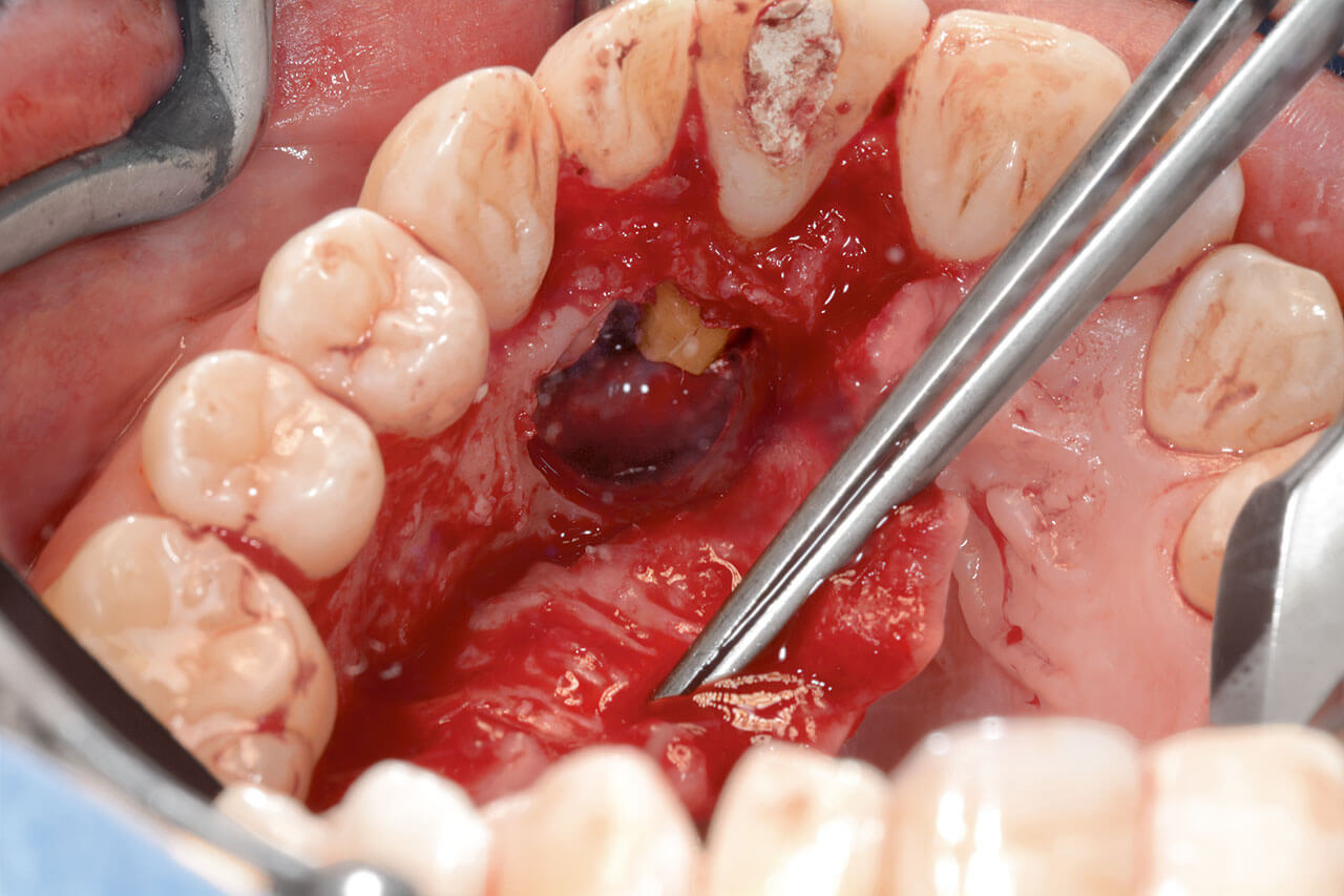 Abb. 12 Zustand nach Resektion der Wurzelspitze.