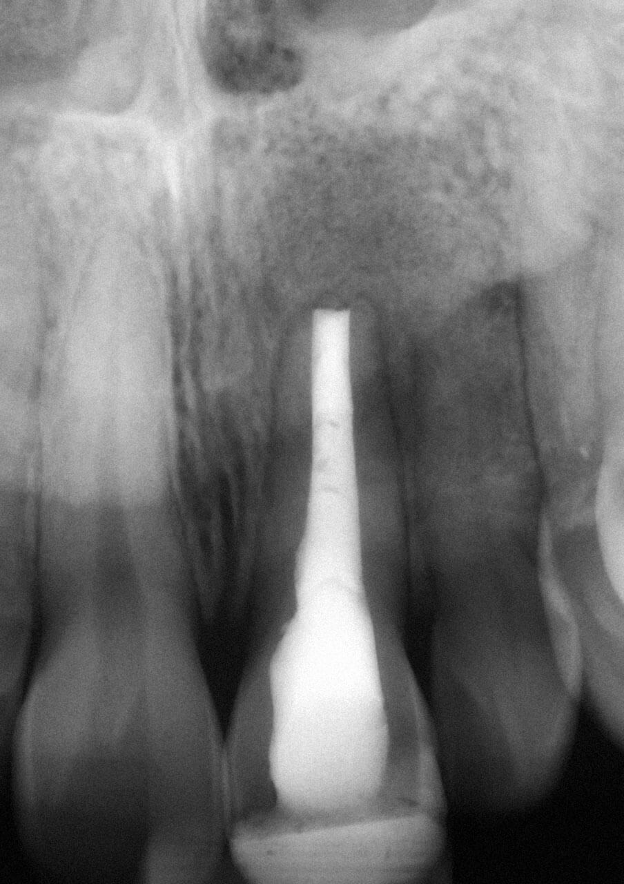 Abb. 15 Die radiologische Kontrolle nach 9 Monaten zeigt eine deutliche Besserung der periapikalen Verhältnisse.