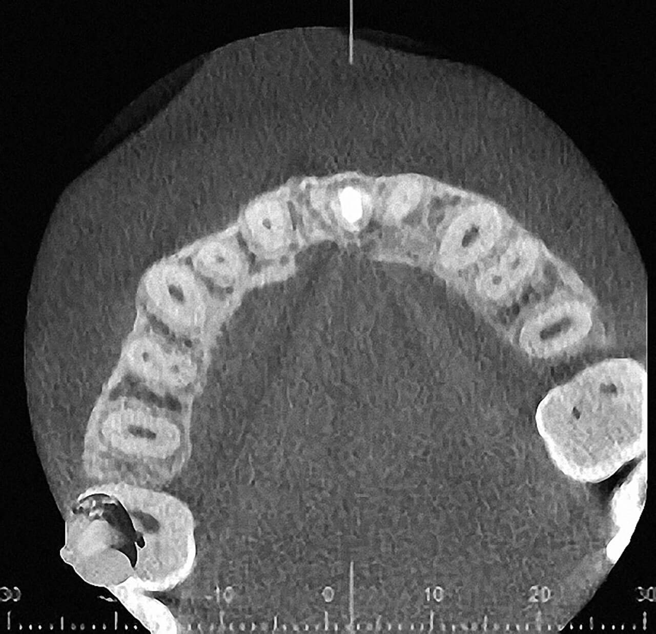 Abb. 16 und 17 Kontroll-DVT 12 Monate postoperativ: Vollständige knöcherne Regeneration des zystischen Defektes in Region 21.