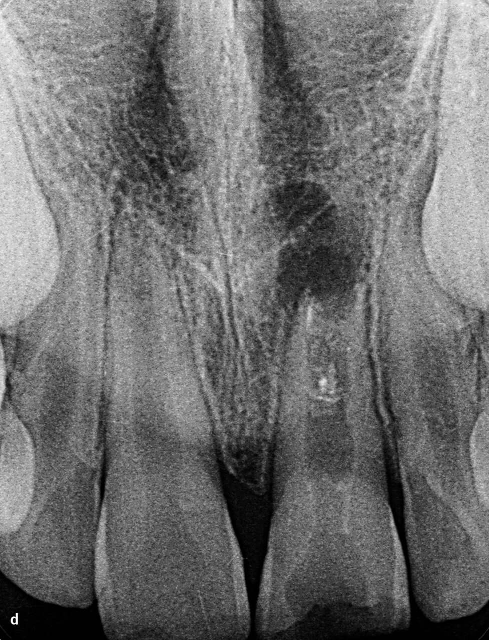 Abb. 1d Das Wurzelwachstum des Zahnes 21 ist nicht abgeschlossen. Röntgenologisch ist eine ausgedehnte apikale Läsion zu erkennen. Intrakanalär sind Reste einer medikamentösen Einlage zu vermuten. Die Wurzel des Zahns 11 ist regelrecht ausgebildet.