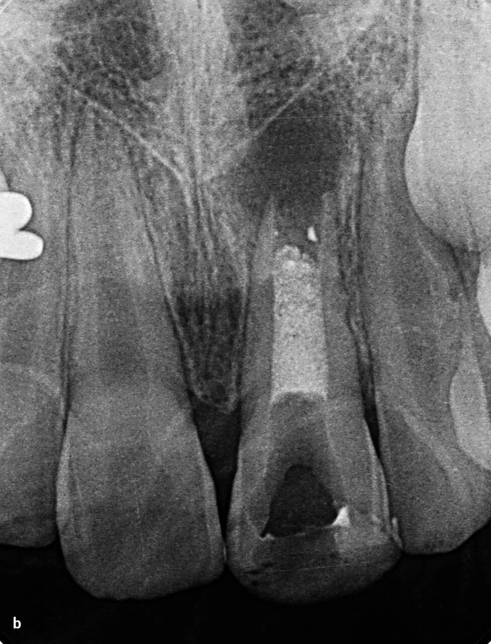 Abb. 7b zweite Röntgenkontrollaufnahme: Der MTA-Plug befindet sich in korrekter Position entsprechend der vorherigen röntgenologischen und elektrischen Längen­messung.
