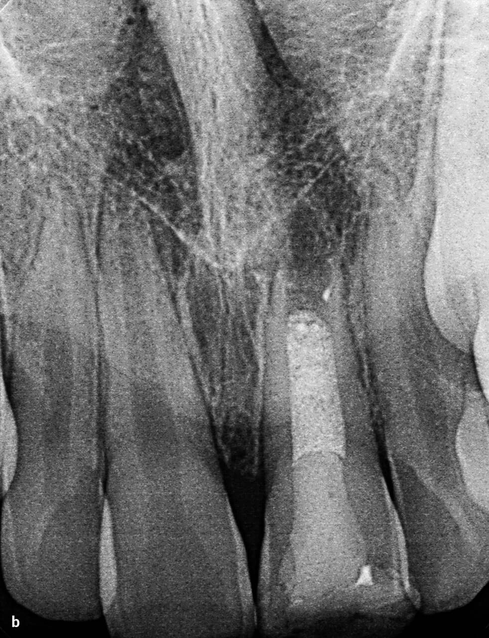 Abb. 9 b Die röntgenologische Nachkontrolle zeigt eine noch erkennbare, aber rückläufige Aufhellung im Bereich der Wurzelspitze des Zahns 21. 