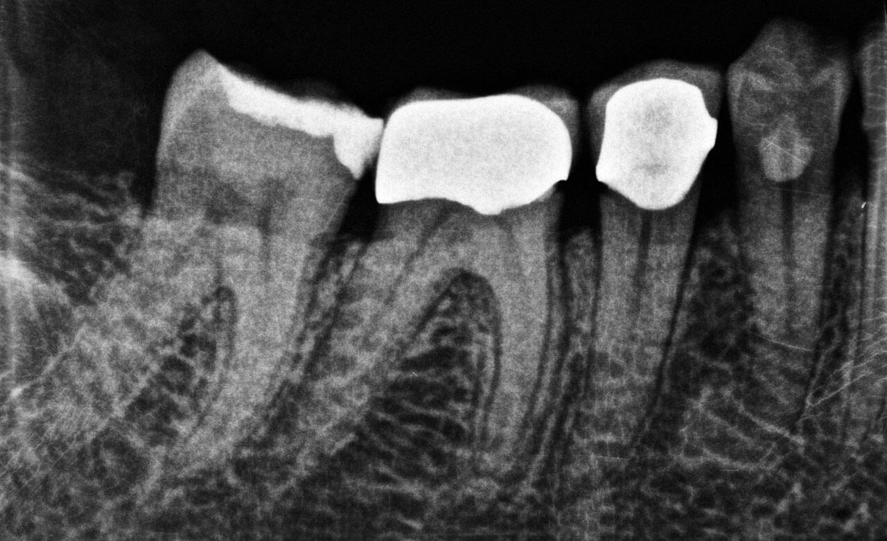 Abb. 1 Diagnostisches Röntgenbild: insuffiziente Kronen­ränder an den Zähnen 45 und 46. 