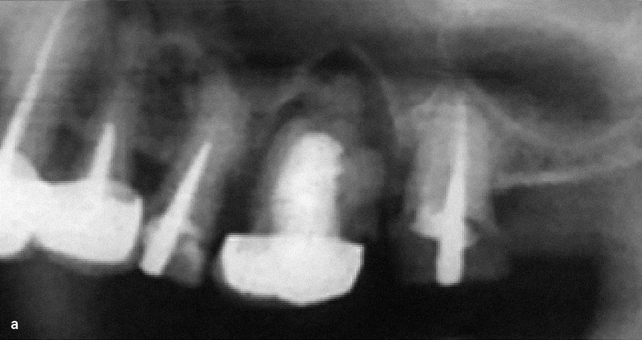 Abb. 3a Zahn 26 mit individuell hergestelltem Stiftaufbau und Parodontitis apicalis (Ausschnittvergrößerung aus dem OPG).