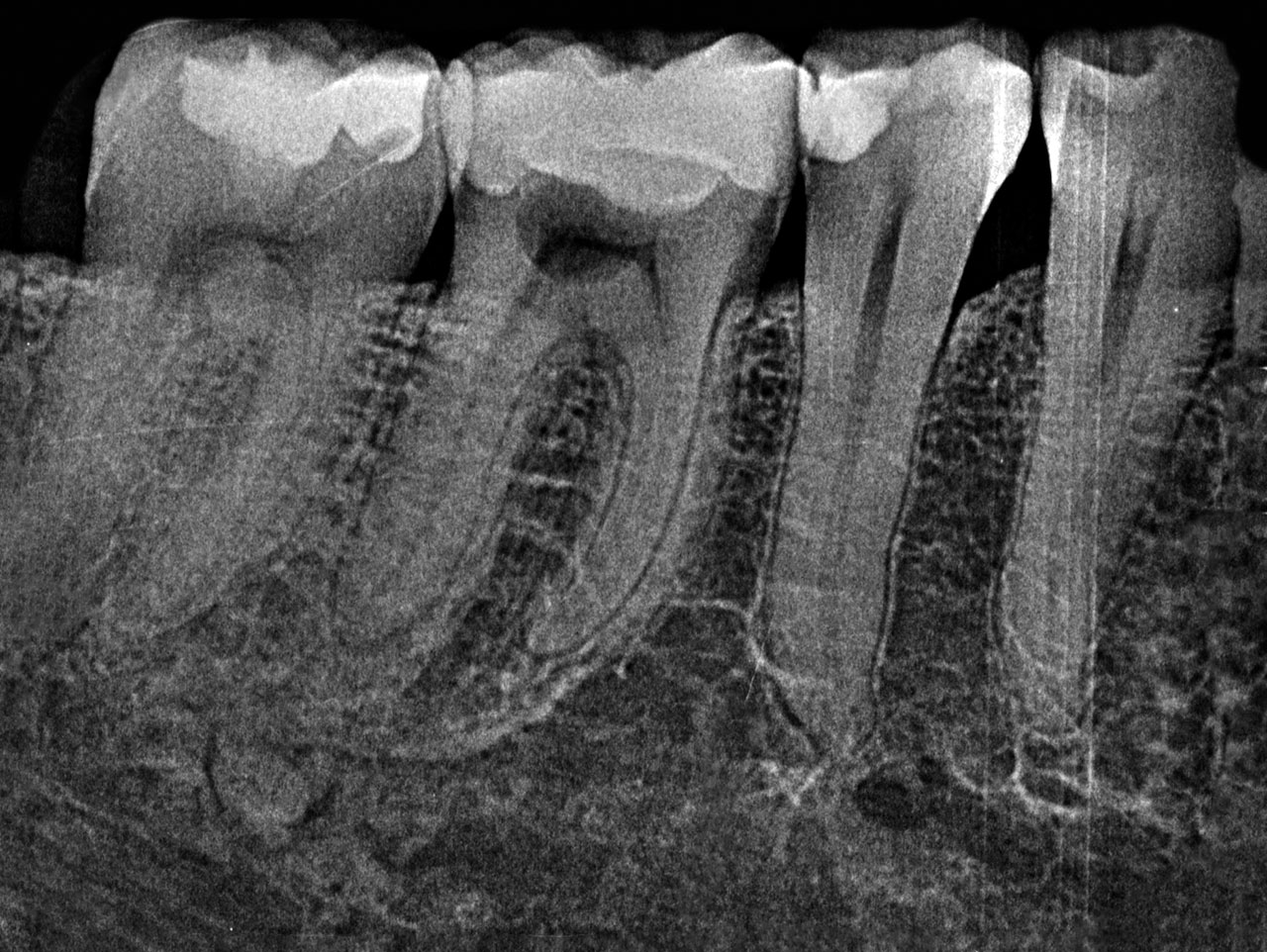 Abb. 1 Ausgangsröntgenbild vom 09.09.2021: Die Resorption stellt sich zervikal als rundliche, die Pulpakammer überlagernde Aufhellung dar.