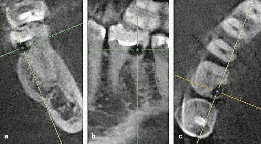 Abb. 3a bis c Die digitale Volumentomografie in frontaler (a), saggitaler (b) und horizontaler Schnittebene (c) zeigt die Resorp­tionsausdehnung mit Beteiligung der Pulpa.