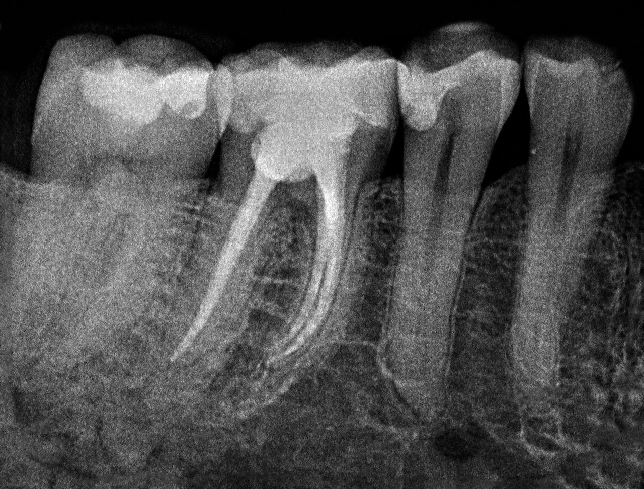 Abb. 13 Radiologisch unauffällige Nachkontrolle in orthoradialer Projektion nach 6 Monaten.