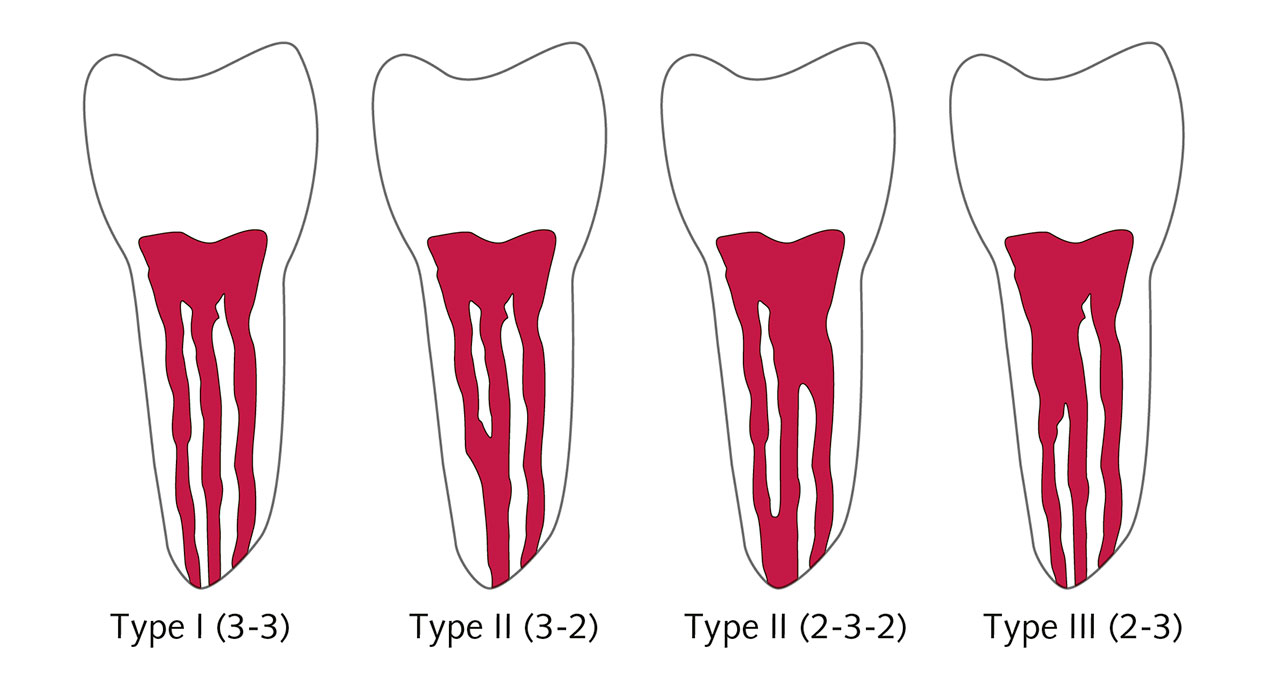 Abb. 1 Wurzelkanalkonfiguration des MMC nach Pomeranz (1981): Typ I (3-3) – „independent type“; Typ II ([3-2, MMC mit eigenem Orifizium] und [2-3-2, MMC entspringt im Verlauf dem MBC oder MLC]) – „confluent type“; Typ III (2-3) – „fin type“.