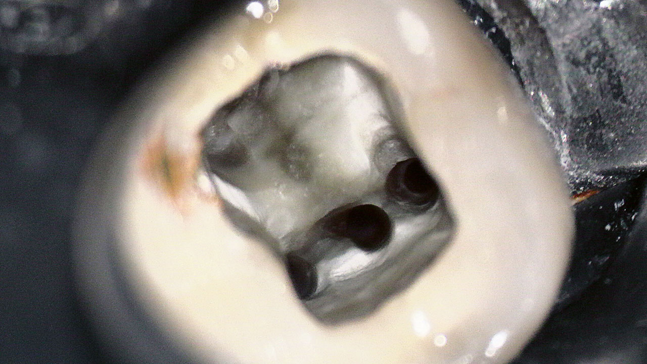 Abb. 4 Nach Erweiterung des Isthmus ist zentral der Eingang eines „middle mesial“-Wurzelkanals zu sehen. 