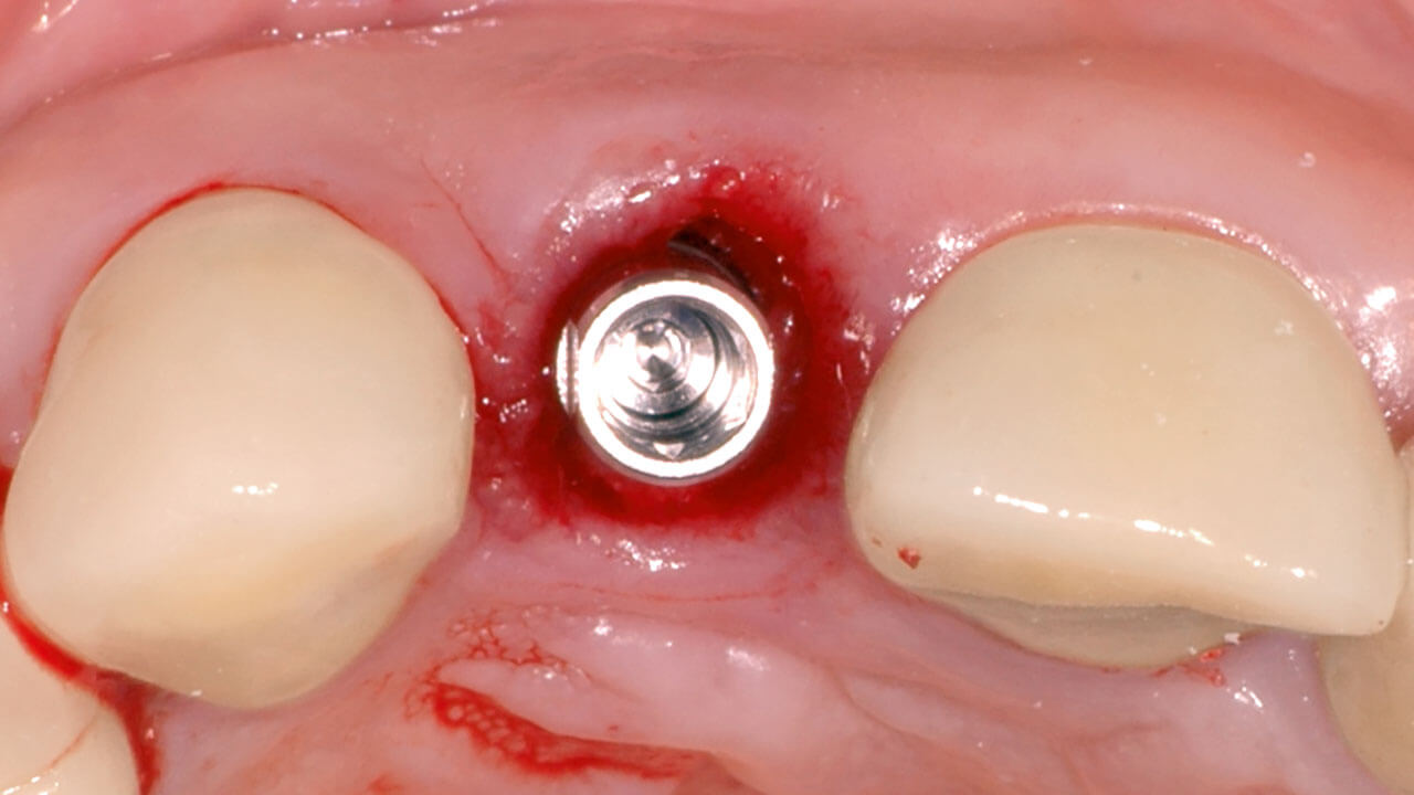 Abb. 4 Das Sofortimplantat wurde leicht nach oral inseriert, um vestibulär einen verbleibenden Spaltraum zwischen bukkaler Alveolenwand und Implantat zu erhalten.