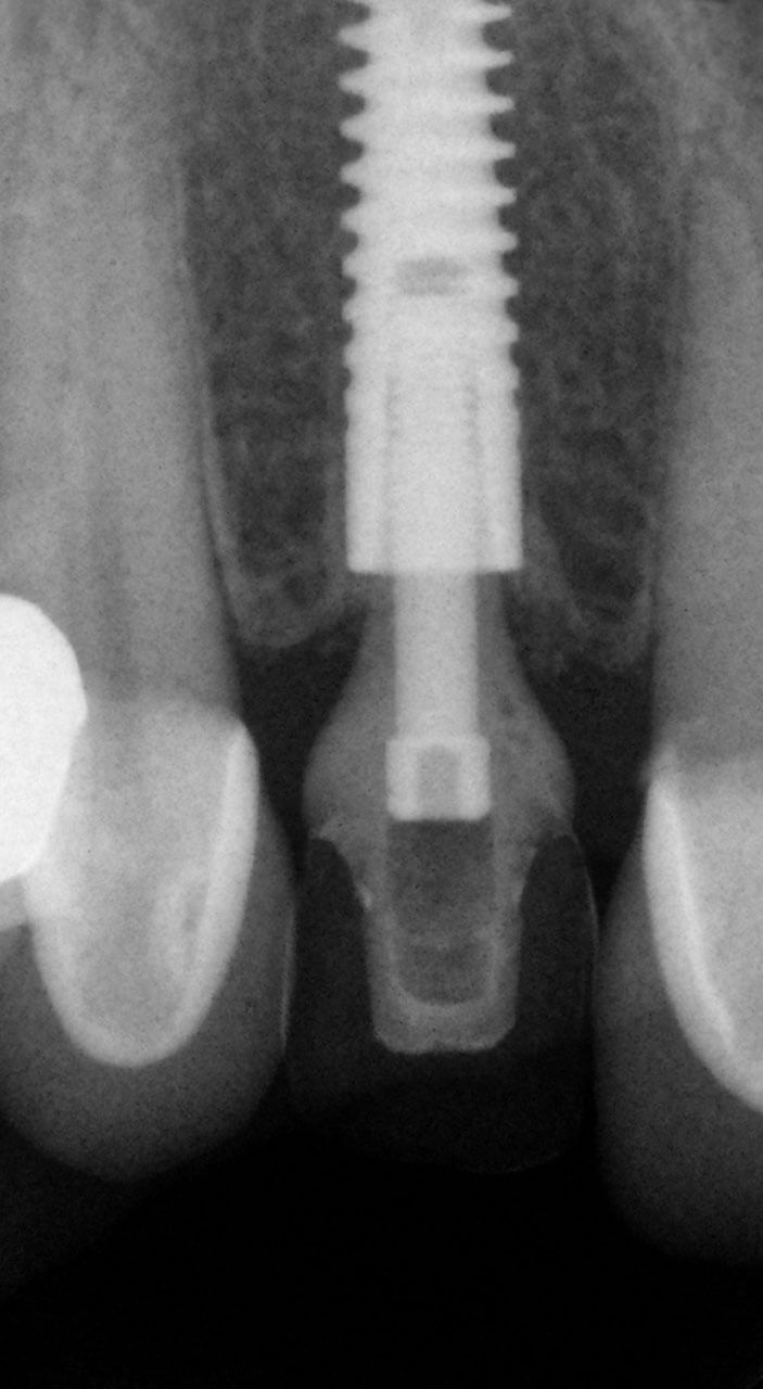 Abb. 9 Der Röntgenzahnfilm 5 Monate nach Sofortimplantation zeigt keine ossären Auffälligkeiten und Knochenablagerungen auf der Implantatschulter.