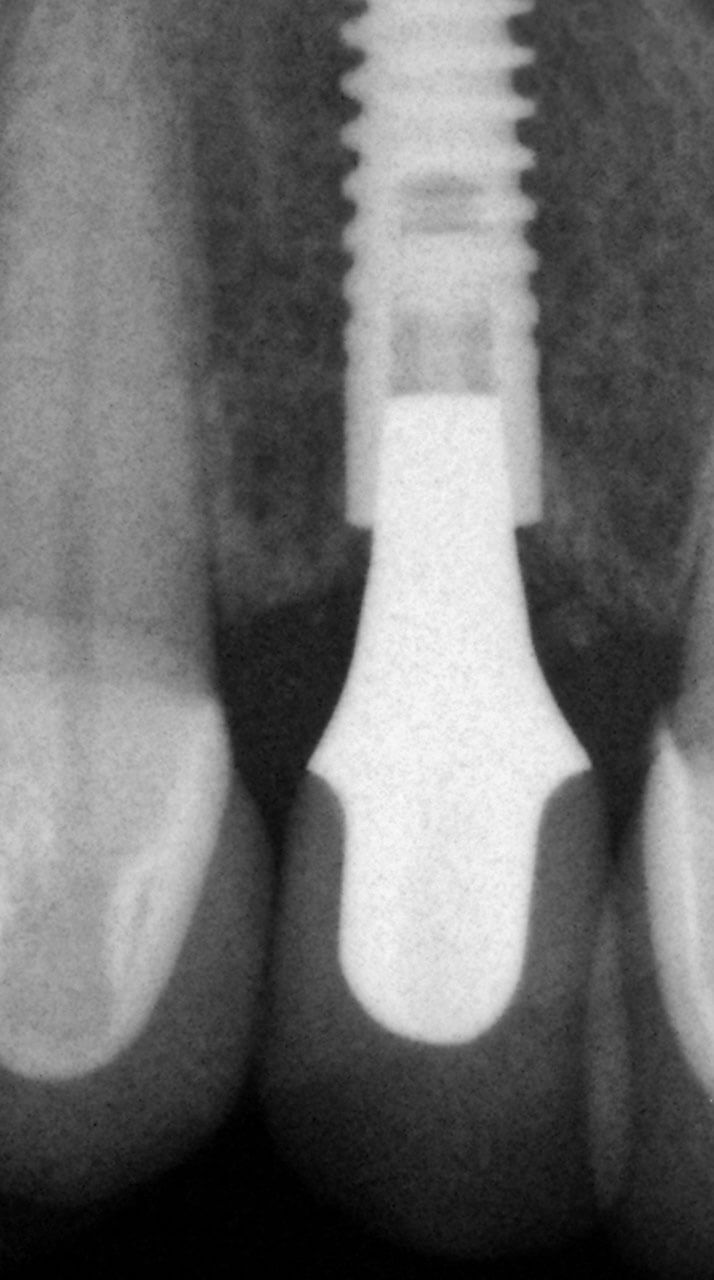 Abb. 14 Röntgenzahnfilm nach definitiver Eingliederung der Implantatkrone 5 Monate nach erfolgter Sofortimplantation.