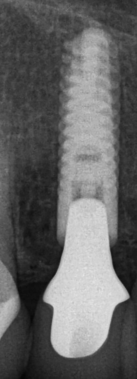 Abb. 15 Röntgenzahnfilm 4 Jahre nach Eingliederung der Implantatkrone zur Kontrolle des periimplantären Knochenniveaus. 