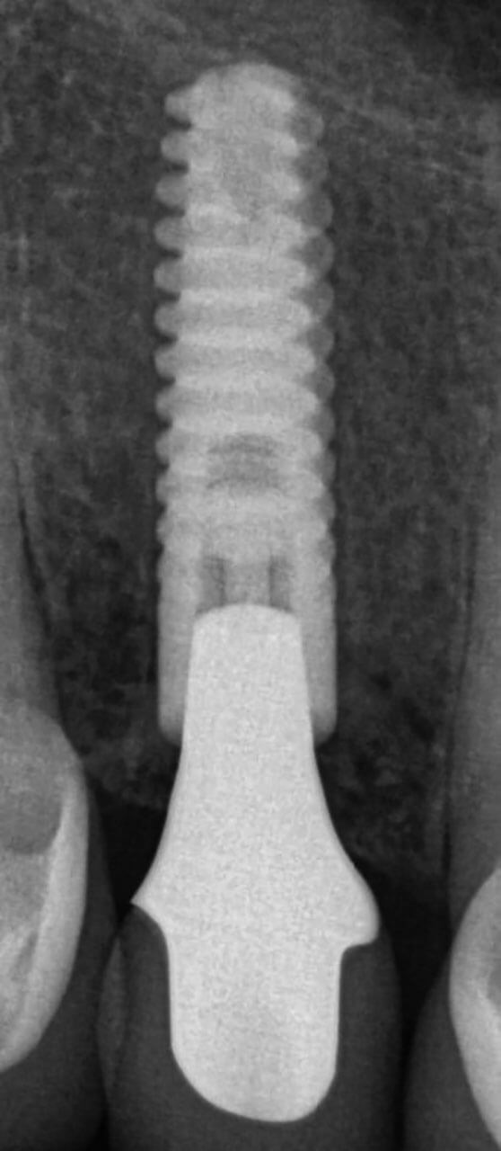 Abb. 16 Der Kontroll-Röntgenzahnfilm 7 Jahre nach Schlusseingliederung zeigt weiterhin stabile Knochenverhältnisse.