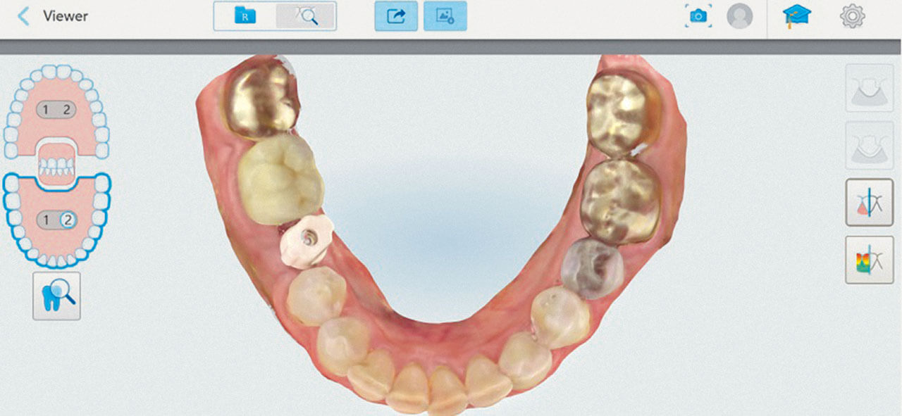 Abb. 2 Scan mit Scanbody.