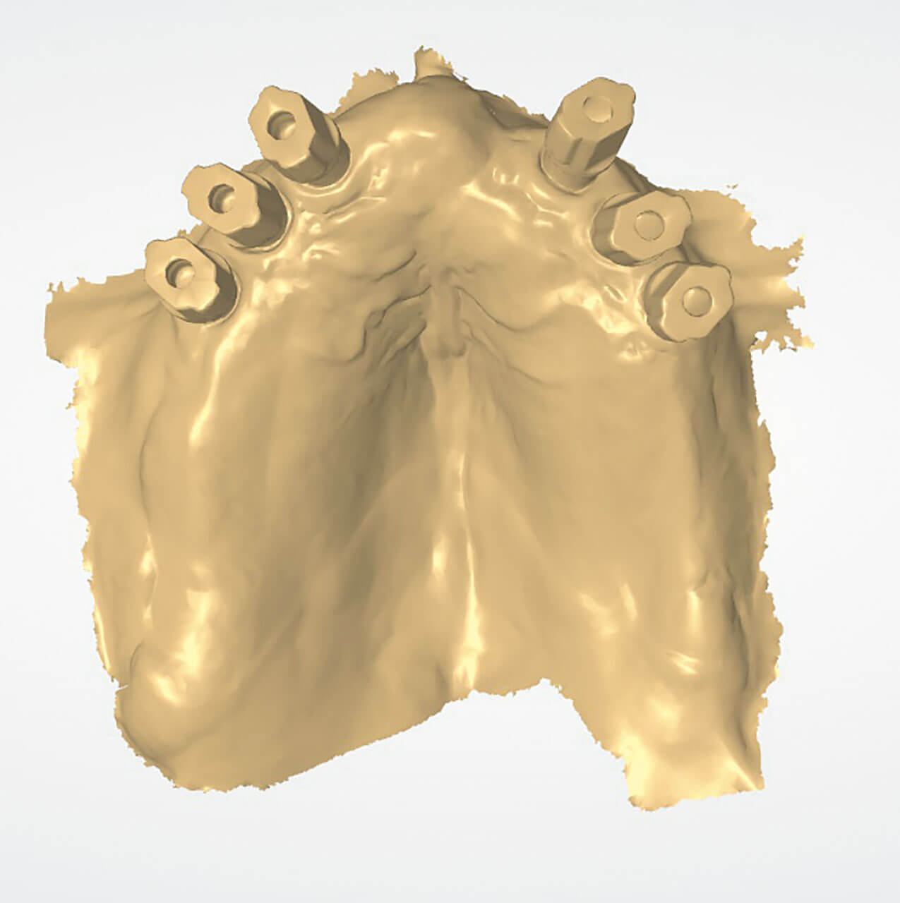 Abb. 7 Scan von 6 Implantaten.