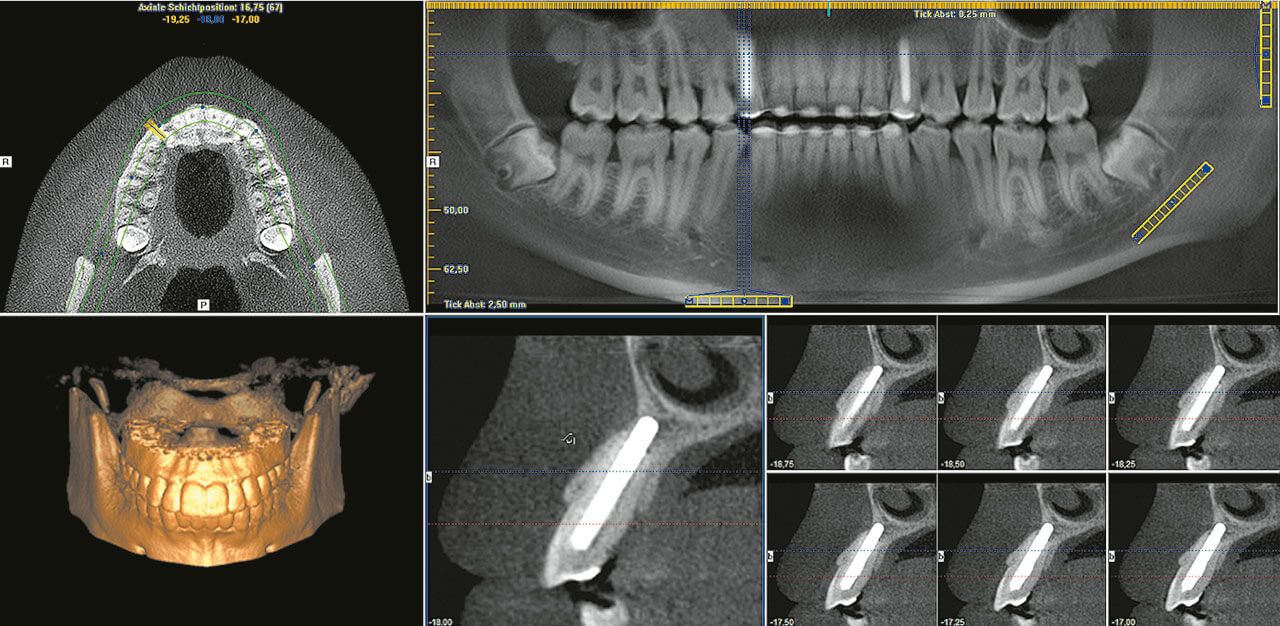 Abb. 11 DVT-Ausschnitt Regio 13 (3 Jahre post OP).