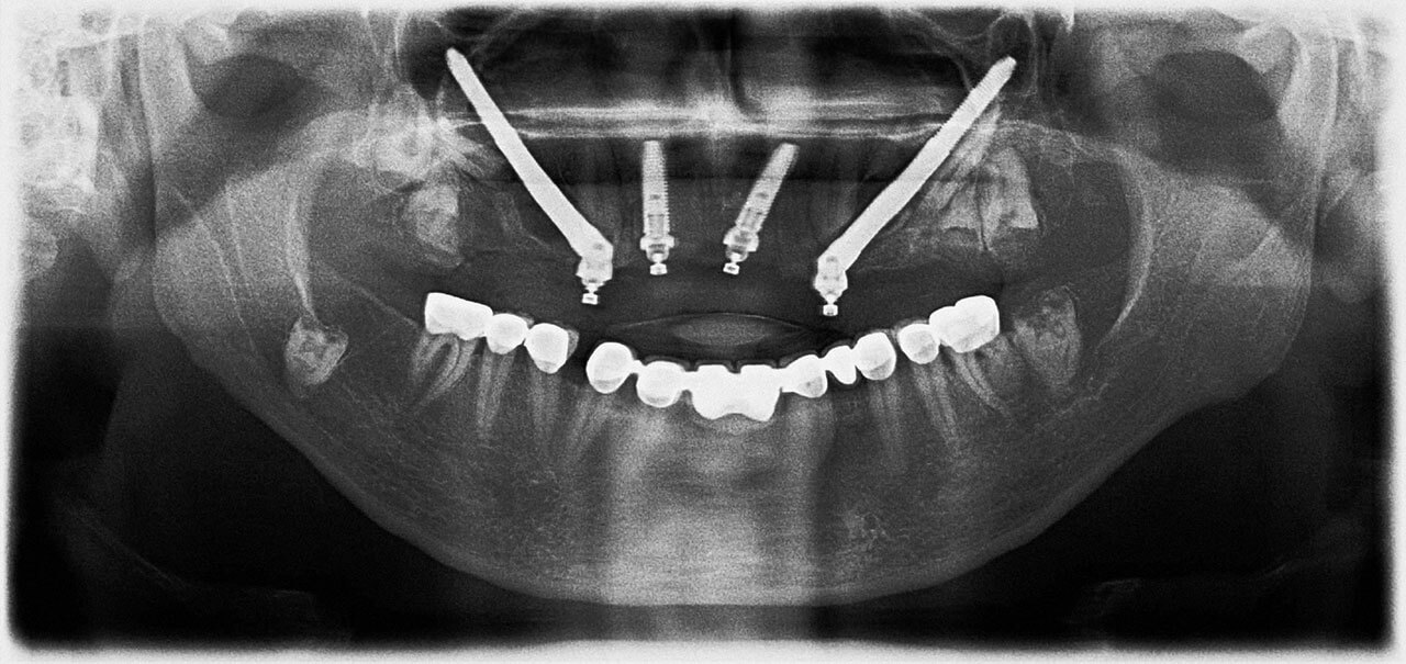 Abb. 11 Postoperative Panoramaschichtaufnahme.