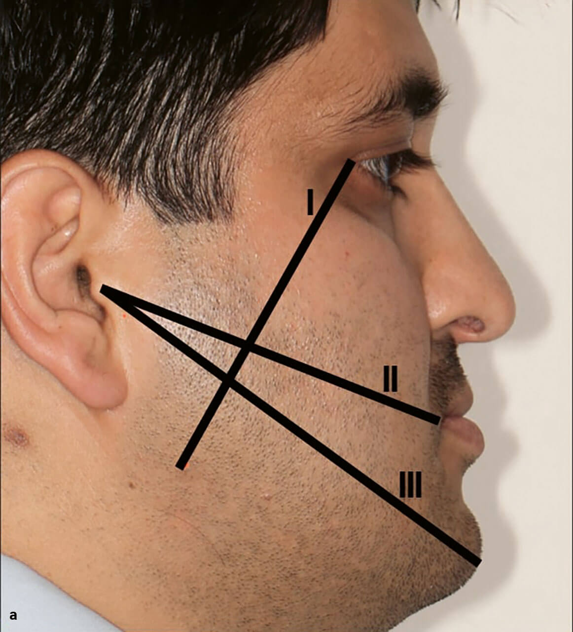 Abb. 13a und b Abstandsmessungen zur Quantifizierung der Schwellung nach Amin und Laskin25. I: Abstand lateraler Augenwinkel – Kieferwinkel, II: Abstand Tragus – Mundwinkel, III: Abstand Tragus – Pogonion.