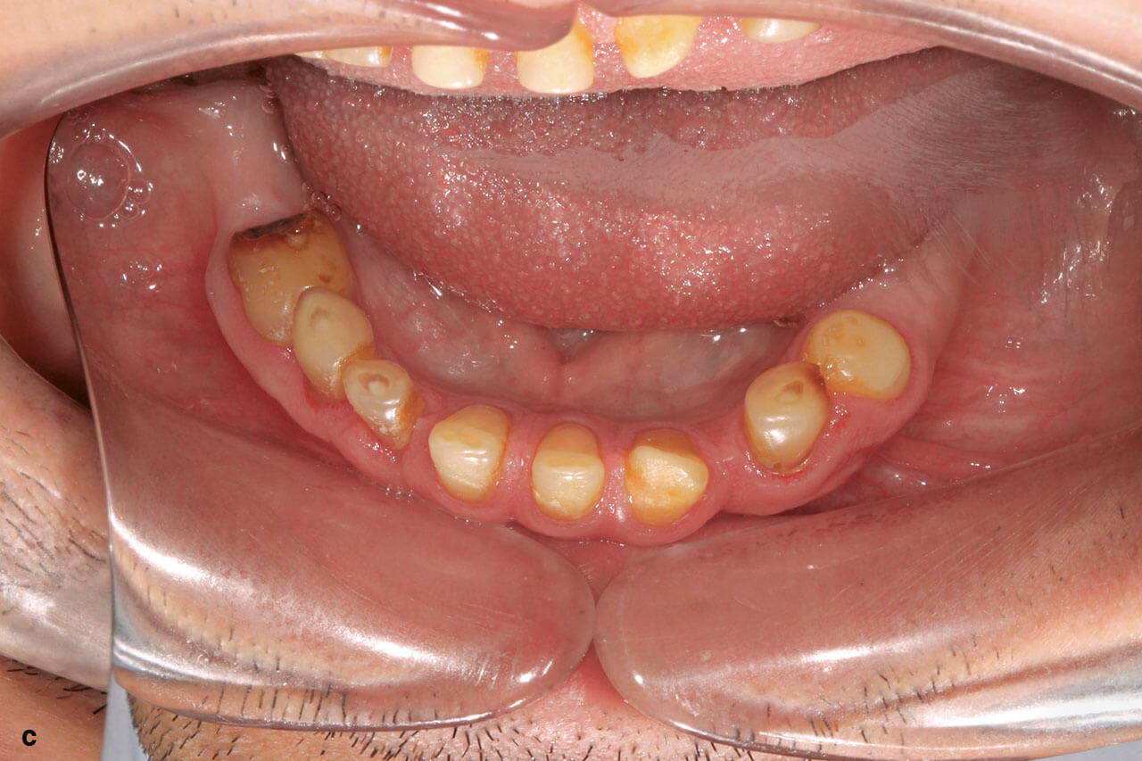 Abb. 1a bis d Patient 1: Intraorale Ausgangssituation.