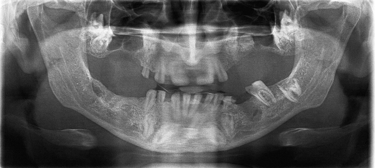 Abb. 2 Präoperative Panoramaschichtaufnahme.