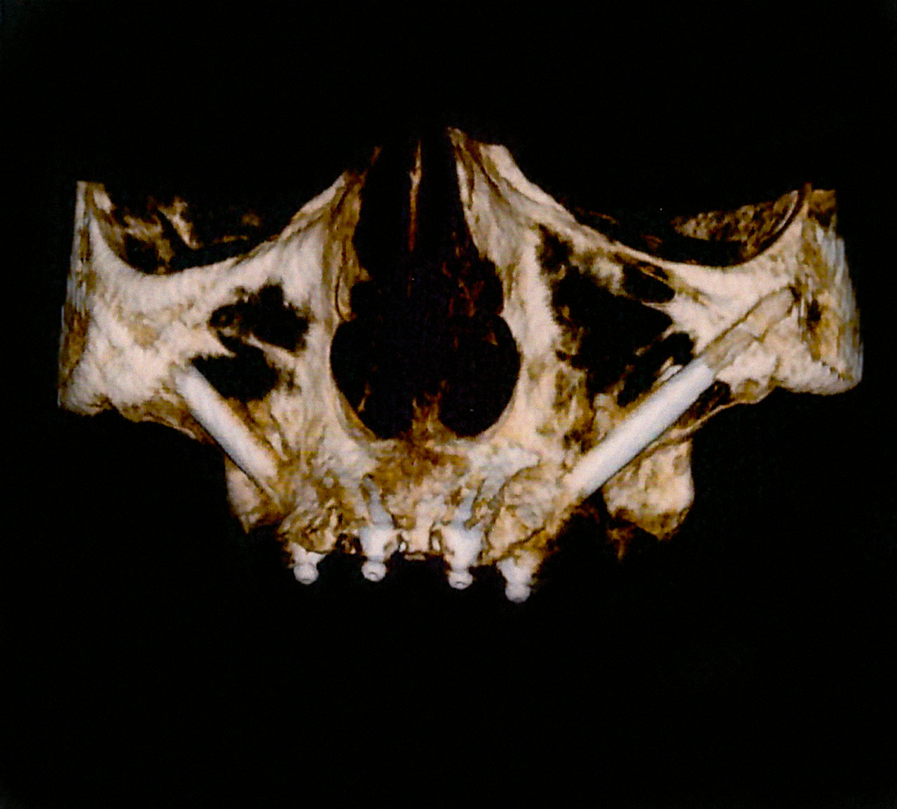 Abb. 4 Postoperative Kontroll-DVT.