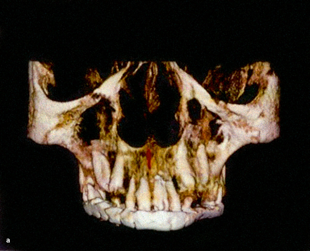 Abb. 9a bis f Präoperative DVT.