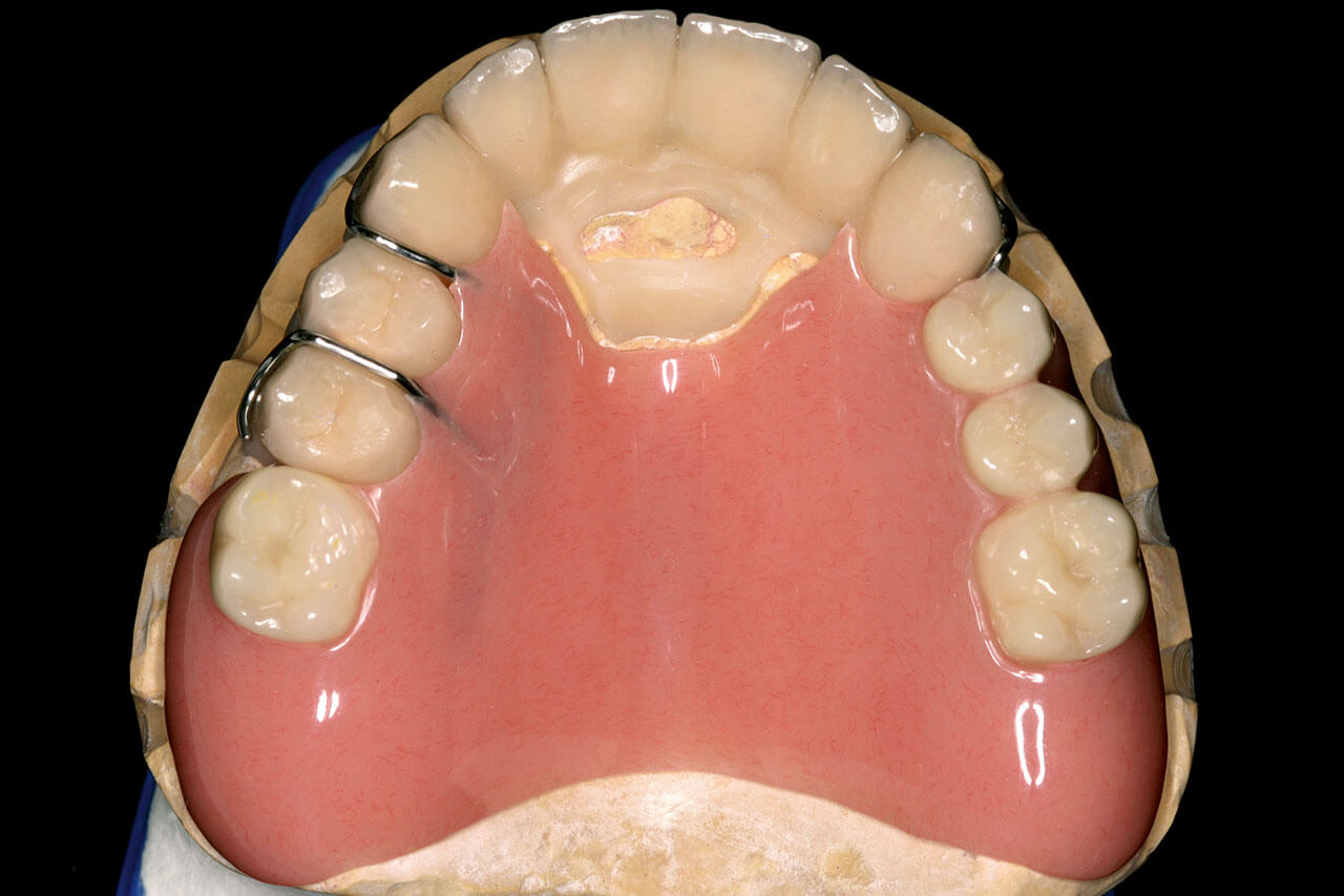 Abb. 3 Schalenprovisorium und Interimsersatz mit Drahtklammern auf dem Modell.