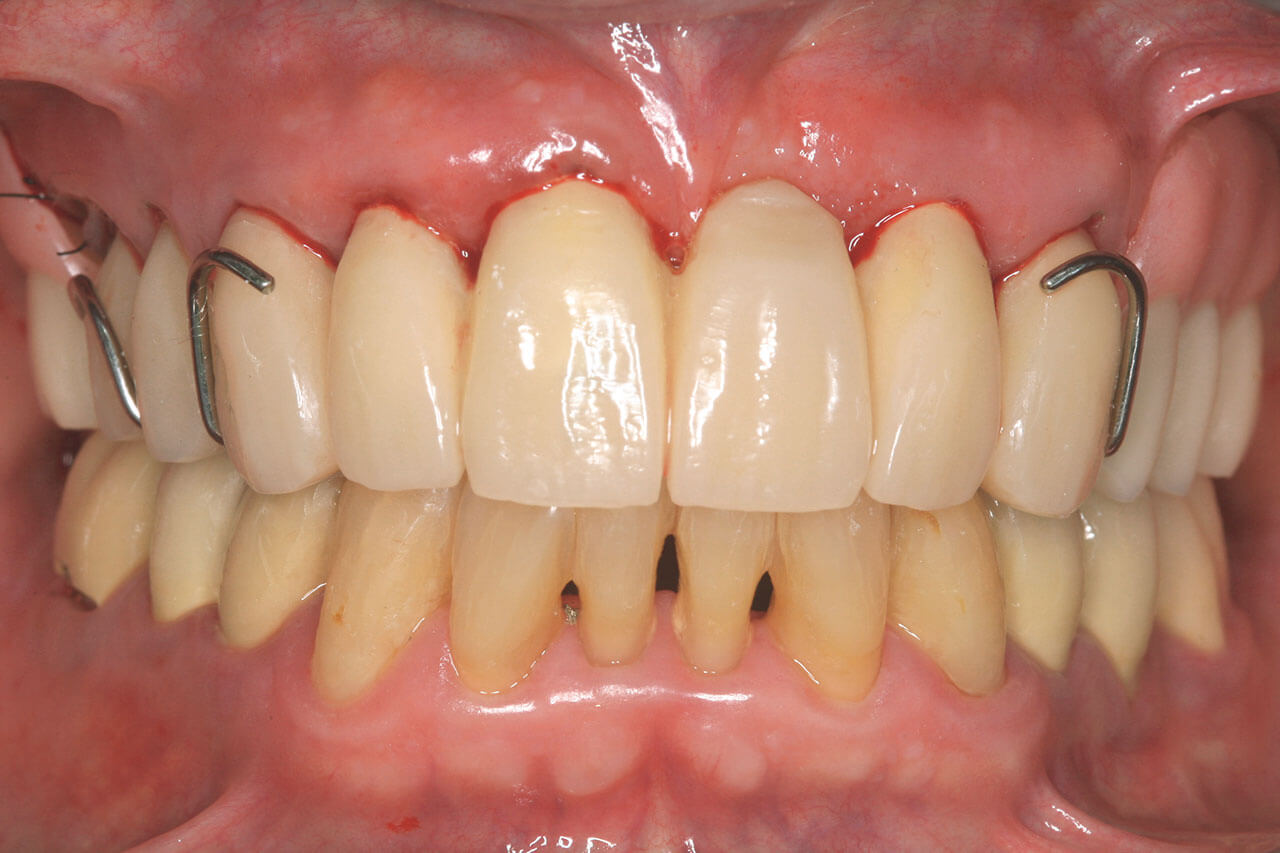 Abb. 5 Schalenprovisorium 15−23 mit Interimsersatz mit Kunststoffbasis und Drahtklammern (Frontalansicht).