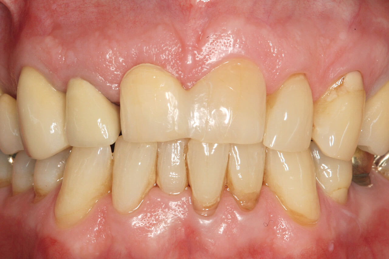 Abb. 19 Approximal eingeklebter Zahn 11 nach ­Implantation (Frontalansicht).