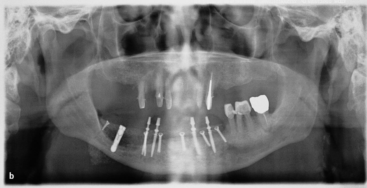 Abb. 1b Provisorische Implantate in situ nach der Auflagerungsosteoplastik mit Beckenkammtransplantat.