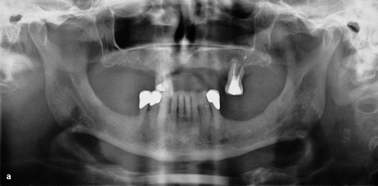 Abb. 2 a Präoperative Panoramaschichtaufnahmen nach der Inser­tion von definitiven und provisorischen Implantaten.