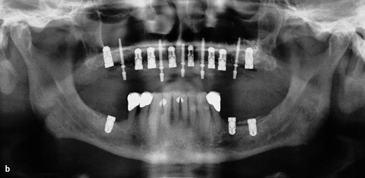 Abb. 2 b Postoperative Panoramaschichtaufnahmen nach der Inser­tion von definitiven und provisorischen Implantaten.