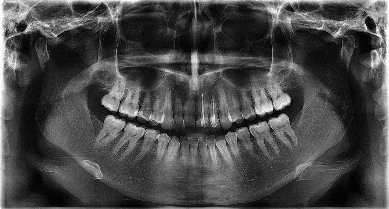 Abb. 14 Orthopantomogramm: deutlich zu erkennen die zwei wurzelbehandelten Inzisiven im II. Quadranten, welche Zeichen der Wurzelresorption aufweisen.