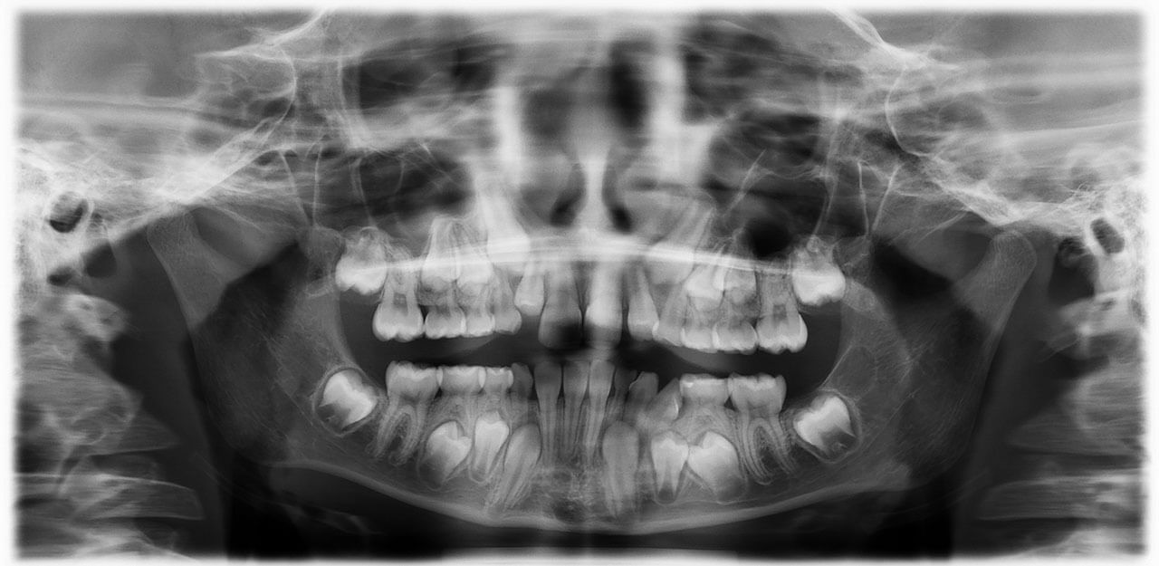 Abb. 1 Panoramaschichtaufnahme zur Überprüfung des Verdachts auf ­Transposition der Zähne 32/33, Zahn 32 projiziert sich in Regio 34, während sich Zahn 33 in ­Regio 32 projiziert.