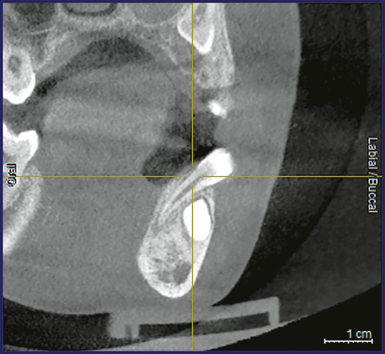 Abb. 2 Durch eine digitale Volumentomografie konnte die Wurzel des Zahns 32 lingual des Zahnkeims 34 lokalisiert werden.