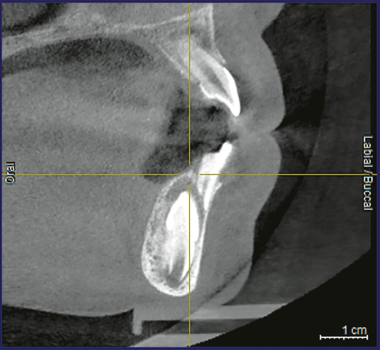 Abb. 3 Zahn 33 zeigte sich hingegen nach vestibulär verlagert. Die entgegengesetzte Lage der Zähne 32 und 33 in oro-vestibulärer Richtung erschien günstig zur Auflösung der Transposition.