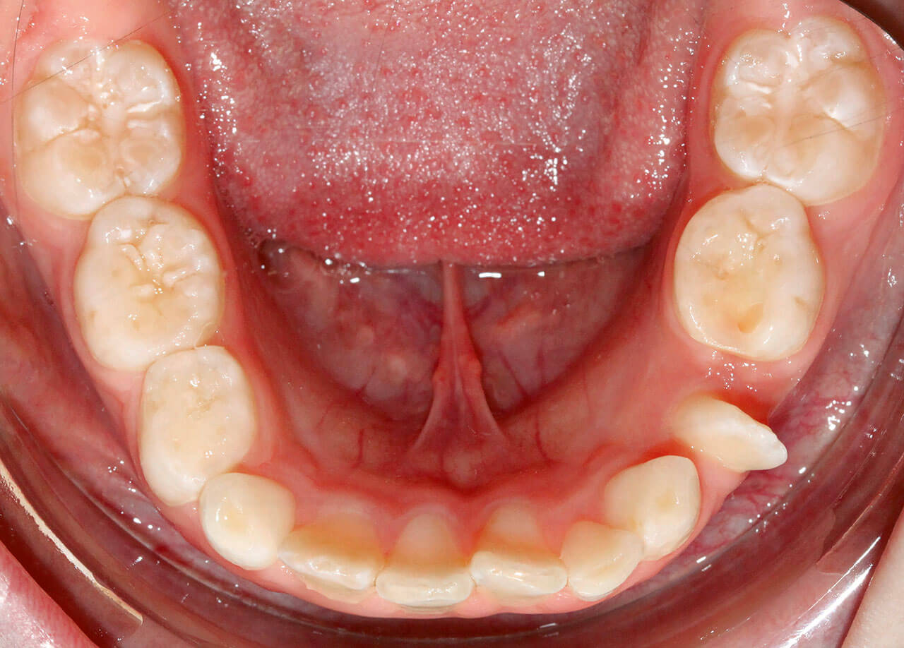 Abb. 4 Klinische Ausgangssituation: Zahn 32 ist in stark mesiorotierter Position in Regio 34 zu erkennen. 