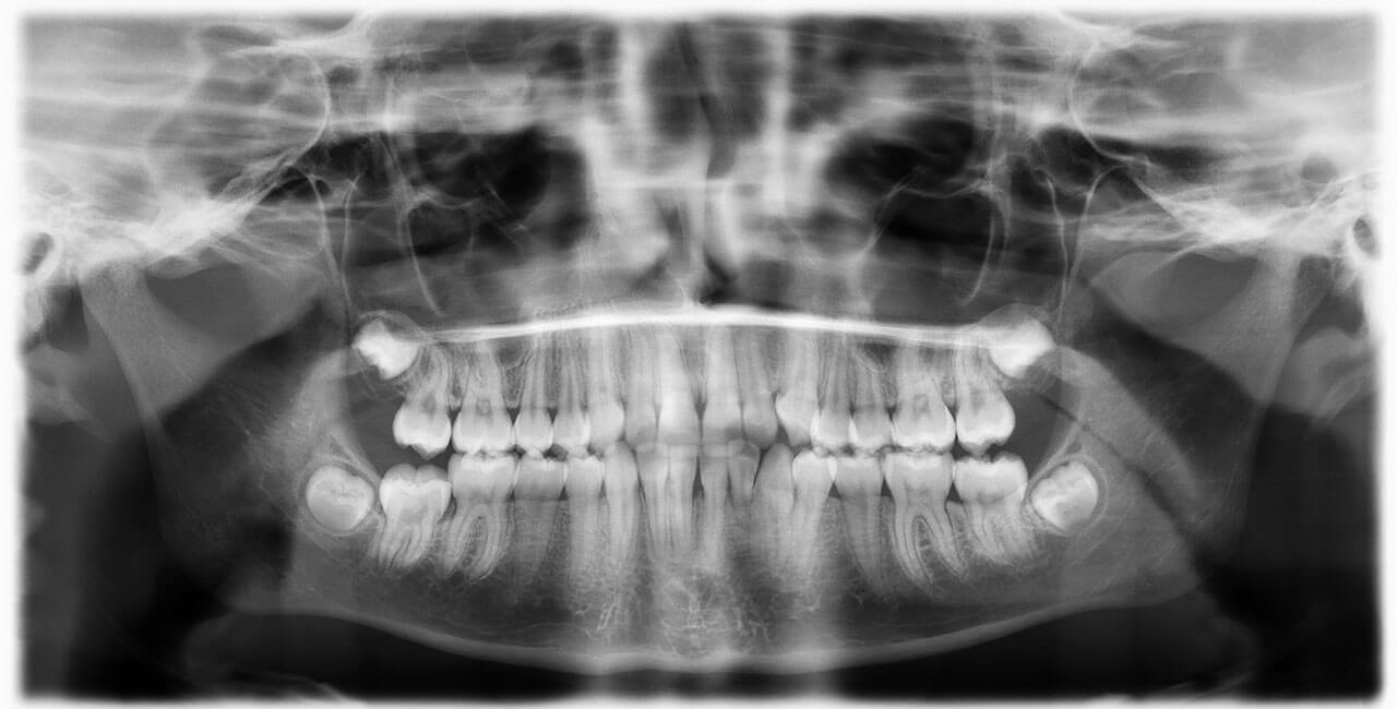 Abb. 10 Panoramaschichtaufnahme  vor Beginn der Multibandbehandlung. Es zeigte sich eine enge Lagebeziehung der Wurzeln 33 und 32, zudem ergab sich der Verdacht auf eine  Dilazeration und Resorption im Bereich der Wurzel 32, was jedoch auch durch die protrudierte Stellung des Zahns bedingt sein kann. Zahn 33 weist zwei Wurzeln auf.