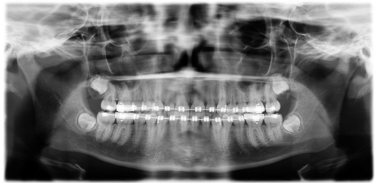 Abb. 13 Die Panoramaschicht­aufnahme zur Wurzelkontrolle  zeigt eine aus­reichende Distanz der Wurzeln der Zähne 32 und 33, während enge Lagebeziehungen zwischen den Wurzeln der Zähne 15/14, 12/11 sowie 33/34 bestehen. Im Vergleich zur Panoramaschichtaufnahme vor Insertion der Multibracket­apparatur ist keine Progredienz der Wurzelresorption der Zähne 32 und 33 zu erkennen.