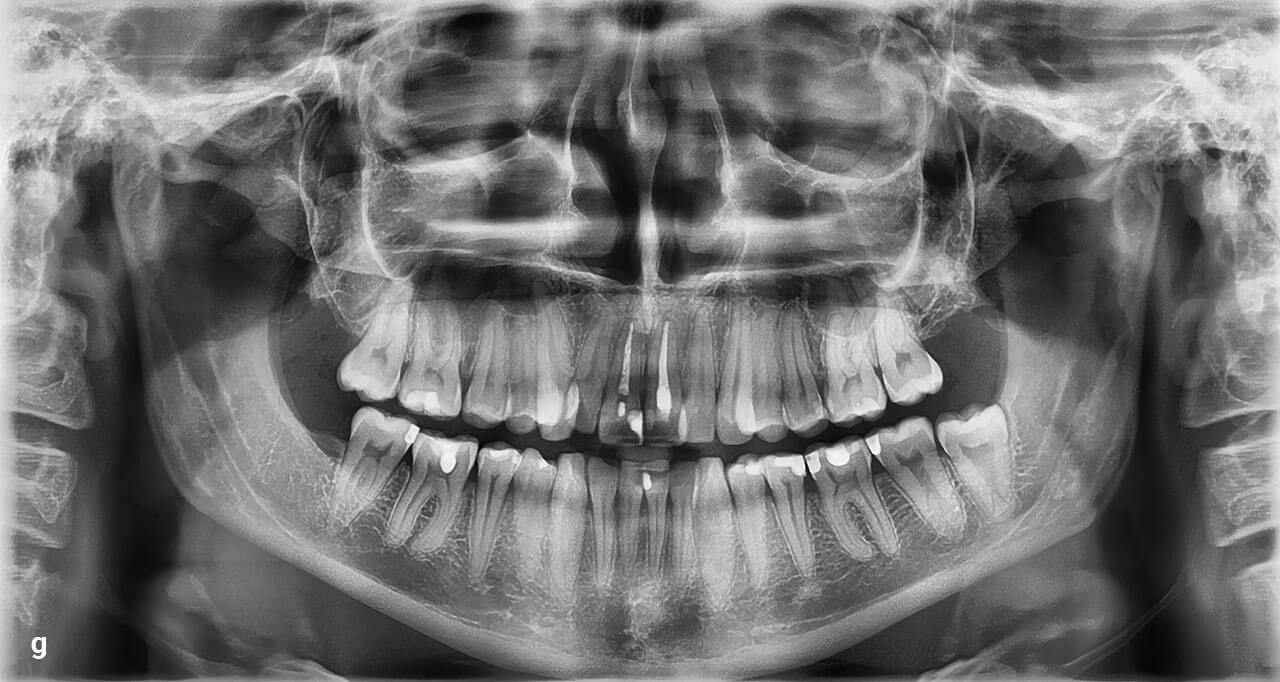 Abb. 1a bis g Klinische und radiologische Ausgangssituation vor Beginn der kieferorthopädischen Behandlung.